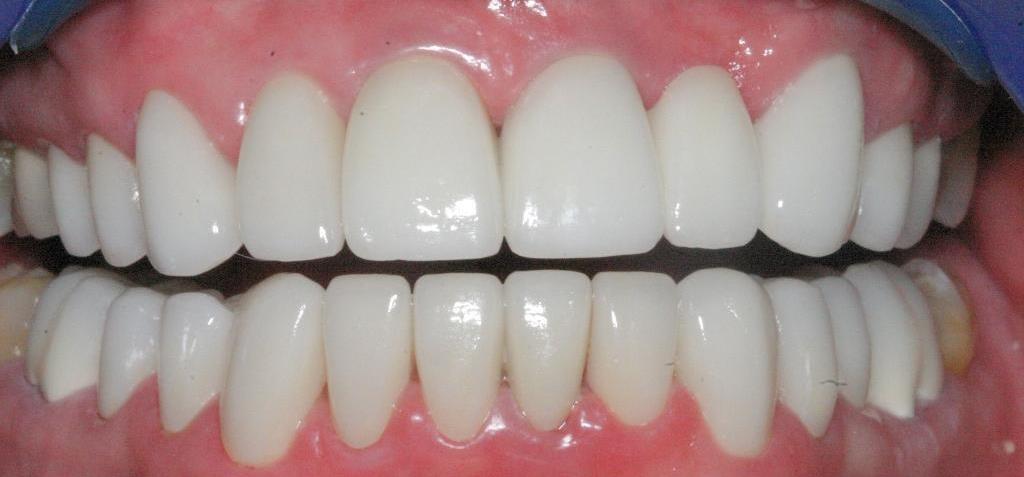 Dental full mouth reconstruction