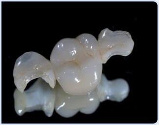 Dental Inlays and Onlays