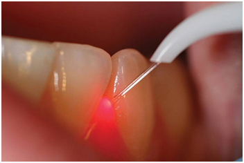 Laser Gum Peeling