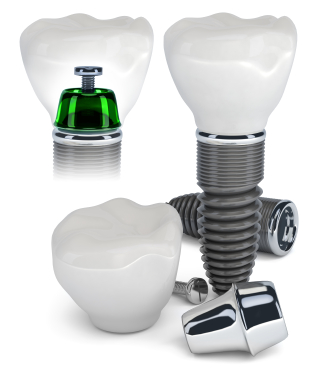 Dental implants